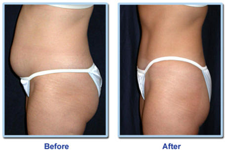 lipo laser treatment before after1