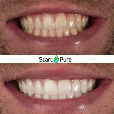 Beforeandafter-puresmile-organic-teethwhitening-portelizabeth
