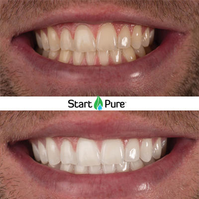 Beforeandafter-puresmile-organic-teethwhitening-portelizabeth Beforeandafter-puresmile-organic-teethwhitening-portelizabeth